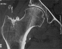 Coxartrosis polar superior incipiente y congestiva.  Reconstrucción frontal de la cadera derecha.