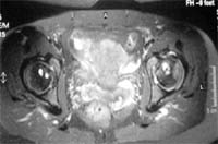 Coxartrosis geódica.  Corte transversal FSE T2 con supresión de la señal de grasa.