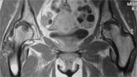 Coxartrosis geódica.  Corte frontal SE T1 inyección de gadolinio.