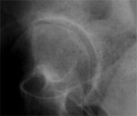 Coxartrosis polar superior incipiente y congestiva.  Radiografía de frente.