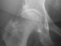 Coxartrosis osteofítica de cadera
