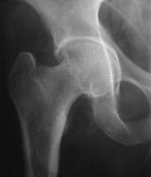 Coxartrosis interna de la cadera con deformación del fondo del cotilo