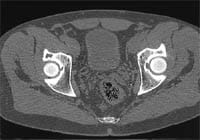 Coxartrosis bilateral por escáner.