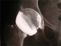 Artrosis coxofemoral.  Artrografía de cadera derecha, de frente.