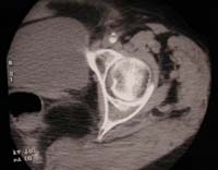 Coxo femoral, TDM