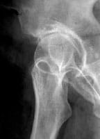 En la incidencia de Lequesne se observa mejor la osteofitosis cotiloidea que afirma la artrosis