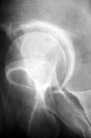 El perfil falso de Lequesne permite visualizar el pinzamiento superior e inferior de la cabeza, y muestra el osteofito que indica la artrosis