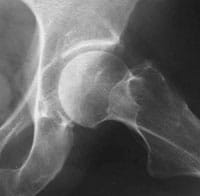 En el perfil de la cadera la osteofitosis es clara tanto a nivel del techo del cotilo como del borde inferior de la cabeza