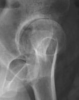 En este perfil falso de Lequesne, se evidencia esta gran artrosis de cadera Estadio III con pinzamiento difuso de la interlínea