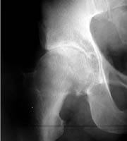 Coxartrosis polar superior con pinzamiento mayor. El diagnóstico de artrosis queda afirmado por la presencia de osteofitos del borde del cotilo.