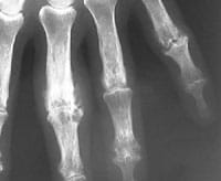 Artrosis erosiva de los dedos