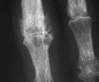 Artrosis erosiva de los dedos
