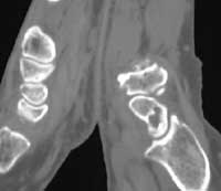 Geoda del escafoides y artrosis escafotrapezoidal