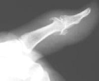 Artrosis interfalángica del pulgar con osteofitosis dorsal y palmar