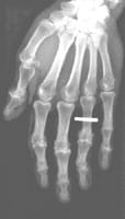 Artrosis destructiva de las interfalángicas proximales de los 2º, 3er y 4º dedos. Artrosis de las IFD de los 4º y 5º dedos. Artrosis de la interfalángica del pulgar