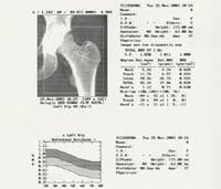 Densitometría de la extremidad superior del fémur Aparato Hologic