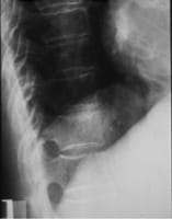 Fracturas vertebrales de T11 cuya deformación no alcanza la disminución de altura del 20% requerida para el grado 1 de GENANT.