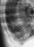 Fractura vertebral de grado 3 de T8 con aspecto denso de la vértebra compatible con una fractura reciente.      Toda fractura vertebral requiere una pesquisa etiológica para poder eliminar una patología secundaria.