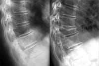 Fractura vertebral incidente de grado 3 de T10