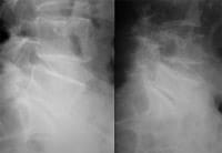 Fractura vertebral incidente de L5: esta fractura aislada requiere un examen etiológico (linfoma&#8230;)
