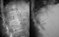 Fractura vertebral incidente de grado 3 de L1, aparecida entre 2 vértebras T12 y L2, sede de fracturas prevalentes. El riesgo de fractura de una vértebra situada entre 2 vértebras fracturadas es grande.