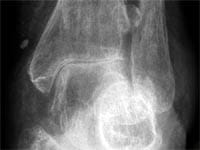Artritis tibiotarsiana