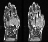 Resonancia magnética de la mano I, secuencias ponderadas T2 en cortes coronales tras saturación de la señal de grasa.