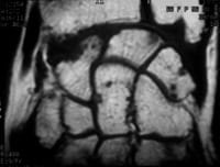 Erosiones óseas: hiposeñal T1, Resonancia magnética del carpo, en ponderación T1, corte frontal.