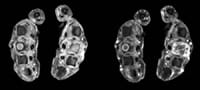 Resonancia magnética de las 2 manos: cortes axiales en secuencias 3D eco de gradiente con supresión de la señal de la grasa con y sin inyección de gadolinio centradas sobre las articulaciones metacarpofalángicas.