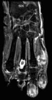 Resonancia magnética mano y muñeca: Corte coronal SE T1 con supresión de la señal de la grasa e inyección de gadolinio.