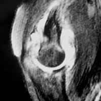 Resonancia magnética del codo: corte sagital FSE T2 con supresión de la señal de grasa.