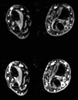 Tenosinovitis ulnares:  Realce de la vaina sinovial tras inyección de gadolinio (2), tendón en corte axial que permanece en hiposeñal.  Resonancia magnética de las 2 muñecas pasando por la articulación radioulnar inferior, secuencias ponderadas T1 tras inyección de gadolinio en cortes axiales (posición de rezo).