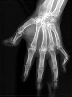 mano reumatoide: pulgar en Z, deformación del 5º dedo en cuello de cisne, carpitis fusionante