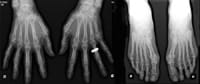 Radiografías de las manos y de los antepiés de frente
