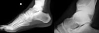 Radiografía del pie y del tobillo de perfil.
