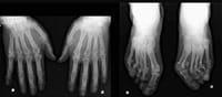 Radiografía de manos y antepiés de cara en el mismo film.  «Ráfaga» fibular, artritis bilaterales, destructivas de los MTP, que engendran una deformación en antepié triangular (Hallux valgus, quintus varus)