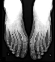 Radiografía de los pies de frente