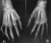 Poliartriris reumatoide:   Artritis radiocarpiana bilateral. Carpitis fusionante bilateral incipiente. Pinzamiento de los MCP bilaterales.