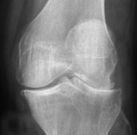 Artritis femorotibial, erosión marginal