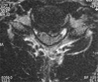 Cervicalgias hernia discal por Resonancia magnética T1