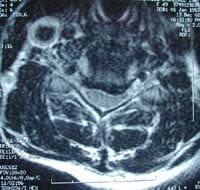 Cervicoartrosis, resonancia magnética secuencia T2, corte frontal
