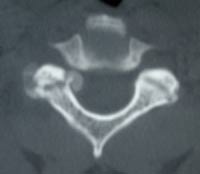 Artrosis interapofisaria posterior C3-C4 izquierda, TDM