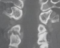Artrosis interapofisaria posterior C3-C4 izquierda, TDM reconstrucción frontal