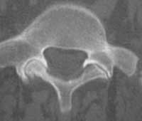 Artrosis articular posterior