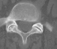 Artrosis articular posterior
