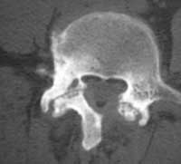 Artrosis articular posterior avanzada bilateral