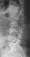 Escoliosis lumbar