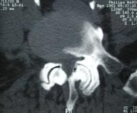 Canal lumbar estrecho por artrosis articular posterior