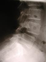 Espondilolistesis L4/L5, por artrosis interapofisaria posterior. Imagen estándar de perfil