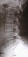 Canal lumbar estrecho por artrosis articular posterior, raquis lumbar de perfil